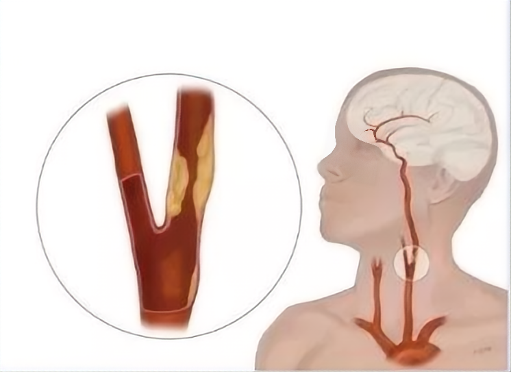 超千万中国人体检结果：两成有颈动脉斑块